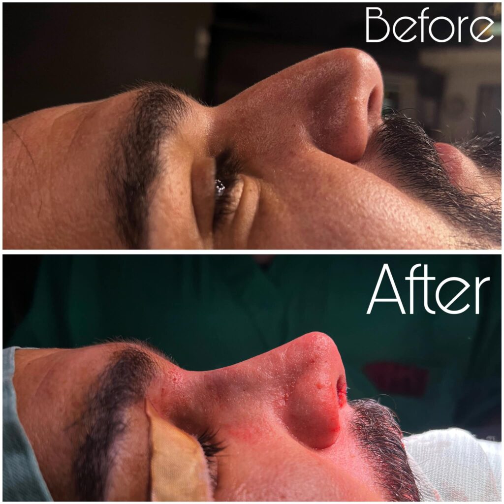 تجميل انف سرجي